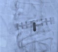 Lumbar pain treatment radiofrequency ablation