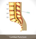 Lumbar puncture