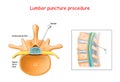 Lumbar puncture procedure Royalty Free Stock Photo