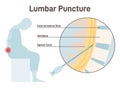 Lumbar puncture. Spinal tap, needle insertion into the space between Royalty Free Stock Photo