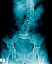 Scoliosis lumbar x-ray image