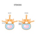 Lumbar Spinal Stenosis Royalty Free Stock Photo