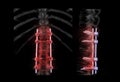 lumbar spine AP and Lateral view for diagnosis spinal canal stenosis and degenerative disc disease showing pedicle screw implant