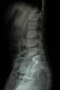 Lumbar spine of child ( X-ray thoracic - lumbar spine ) ( lateral view ) Royalty Free Stock Photo
