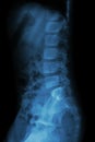 Lumbar spine of child ( X-ray thoracic - lumbar spine ) Royalty Free Stock Photo