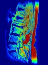 Lumbar spine cystic lesion synovial cyst mri