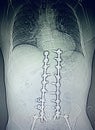 Lumbar spine fusion hardwear stabilization device