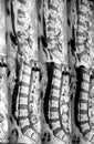 Lumbar spine MRI
