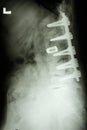 Lumbar spine with pedicle fixation