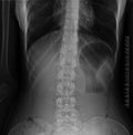 Lumbar spine x-ray Royalty Free Stock Photo