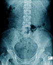 Lumbar spine x-ray image Royalty Free Stock Photo