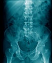 Lumbar spine x-ray image Royalty Free Stock Photo