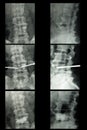 Lumbar spine x-ray, osteoporotic spine