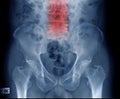 Lumbar spondylosis x-ray image