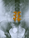 Lumbar spine x-ray showing a spinal fusion Royalty Free Stock Photo