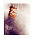 Lumbar spine x-ray showing a spinal fusion Royalty Free Stock Photo