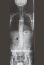 Lumbar spine xray. Front view. Healthcare. Medical examination