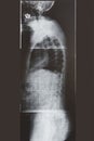 Lumbar spine xray. Side view. Healthcare. Image diagnosis