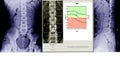 X-ray lumbo-sacral spine and pelvis and inflammation at spine and bone densitometry spine healthcare hospital technology concept