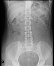 Lumbosacral spine x-ray. Anteroposterior view.