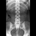 lumbosacral spine x-ray Ap view