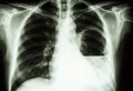 Lung abscess