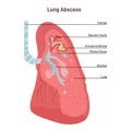 Lung abscess. Microbial infection of the lung causing necrosis of the pulmonary Royalty Free Stock Photo