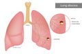 Lung abscess is a type of liquefactive necrosis of the lung tissue. Purulent infiltrate and Necrotic cavity in the lungs Royalty Free Stock Photo