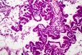 Lung adenocarcinoma