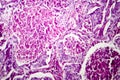 Lung adenocarcinoma, light micrograph