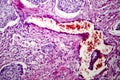 Lung adenocarcinoma, light micrograph