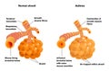 Lung alveoli normal and asthma