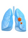 Lung cancer Royalty Free Stock Photo