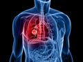 Lung cancer Royalty Free Stock Photo