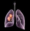 Lung cancer or bronchial carcinoma, 3D medically illustration on black background