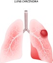 Lung cancer. carcinoma is a malignant lung tumor Royalty Free Stock Photo