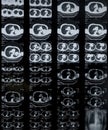 Lung cancer:CT image of chest