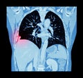 Lung cancer ( CT scan of chest and abdomen : show right lung cancer ) ( Coronal plane )