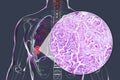 Lung cancer, 3D illustration and light micrograph Royalty Free Stock Photo