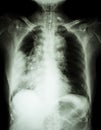 Lung cancer .Film chest x-ray show right lung mass , wide mediastinum , pneumonia and right pleural effusion Royalty Free Stock Photo