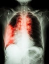 Lung cancer