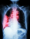 Lung cancer