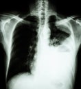 Lung cancer ( film x-ray of chest PA upright : show pleural effusion at left lung due to lung cancer ) ( 2 type of lung cancer : Royalty Free Stock Photo