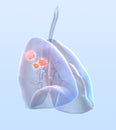 Lung cancer, medically 3D illustration Royalty Free Stock Photo