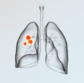 Lung cancer, medically 3D illustration on light background Royalty Free Stock Photo