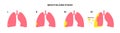 Mesothelioma cancer stages