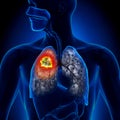 Lung Cancer - Tumor