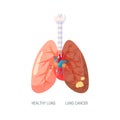 Lung cancer vector concept in flat style