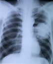 Lung cancer:X-ray image of chest Royalty Free Stock Photo