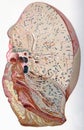 Lung, croupous pneumonia, vintage engraving Royalty Free Stock Photo